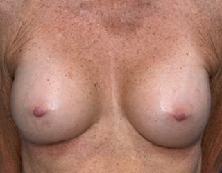 Breast Augmentation Before & After Gallery - Patient 164766 - Image 2