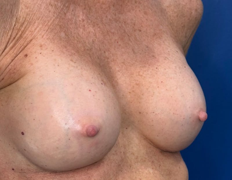 Breast Augmentation Before & After Gallery - Patient 164766 - Image 4