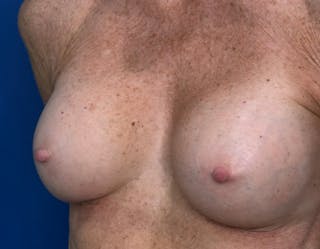 Breast Augmentation Before & After Gallery - Patient 164766 - Image 6