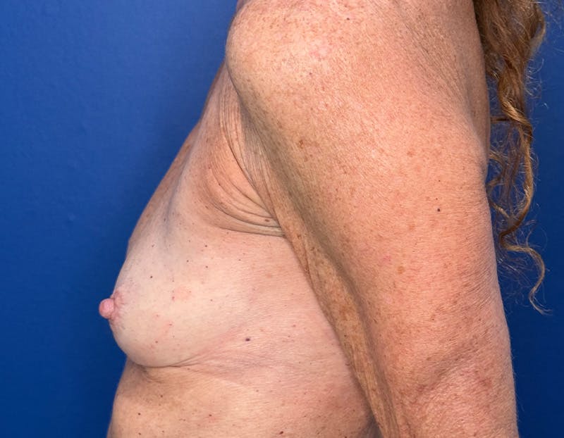 Breast Augmentation Before & After Gallery - Patient 164766 - Image 7