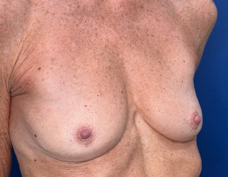 Breast Augmentation Before & After Gallery - Patient 164766 - Image 3