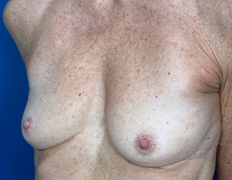 Breast Augmentation Before & After Gallery - Patient 164766 - Image 5