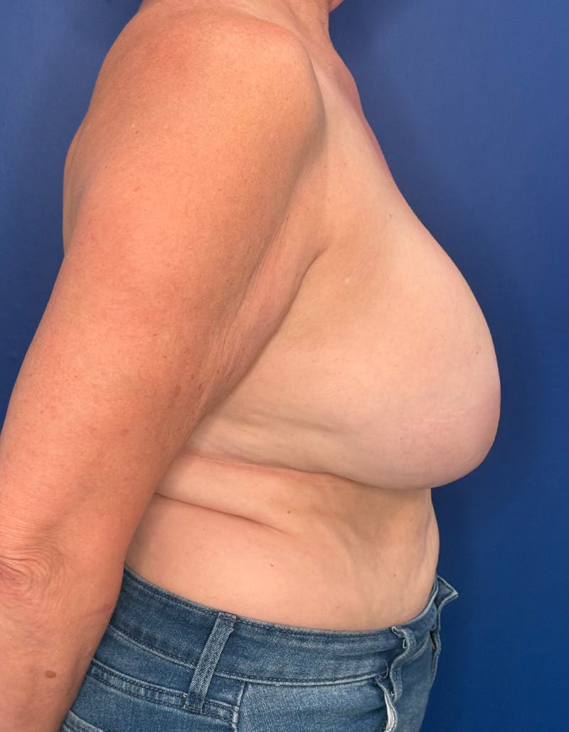 Breast Lift Before & After Gallery - Patient 545806 - Image 5