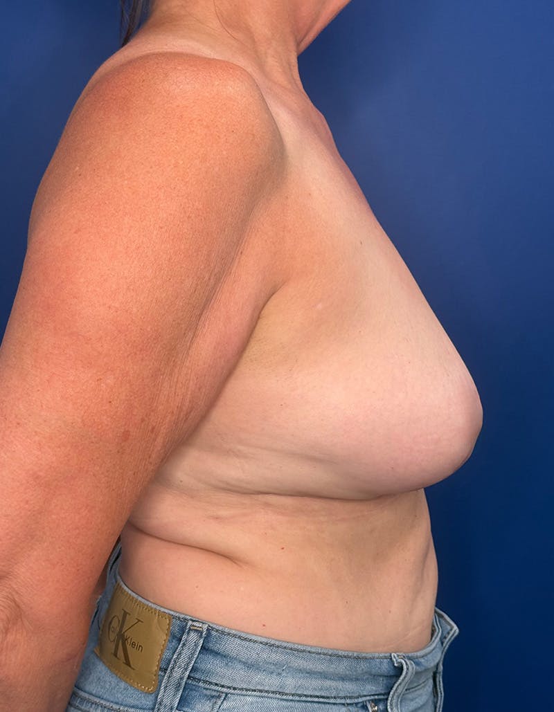 Breast Lift Before & After Gallery - Patient 545806 - Image 6
