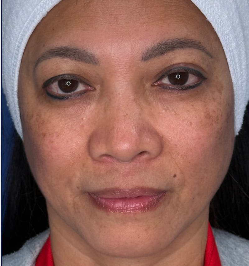 Rhinoplasty Before & After Gallery - Patient 796630 - Image 5