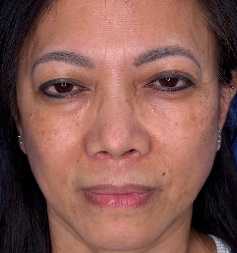 Rhinoplasty Before & After Gallery - Patient 796630 - Image 6