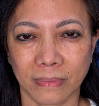 Rhinoplasty Before & After Gallery - Patient 796630 - Image 6