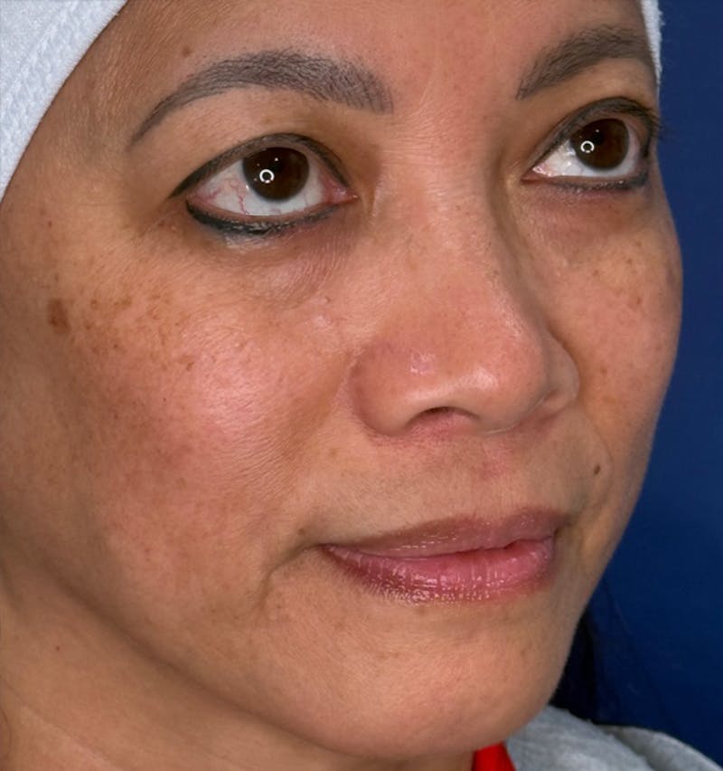 Rhinoplasty Before & After Gallery - Patient 796630 - Image 3
