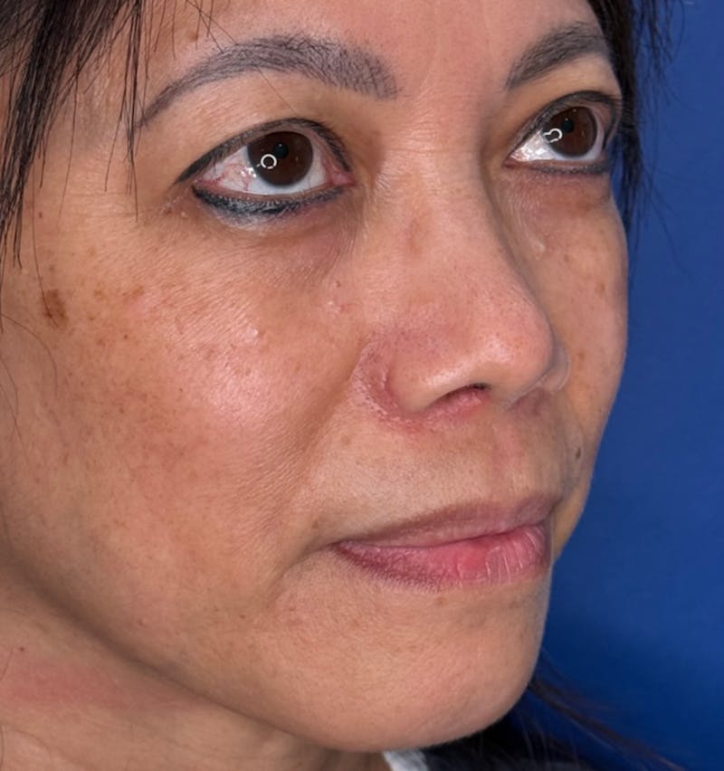 Rhinoplasty Before & After Gallery - Patient 796630 - Image 4