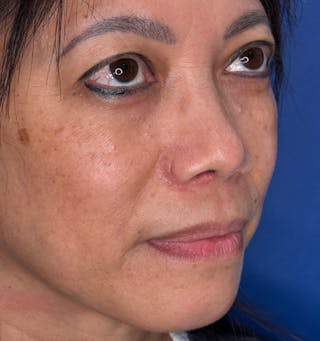 Rhinoplasty Before & After Gallery - Patient 796630 - Image 4