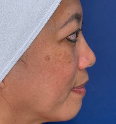 Rhinoplasty Before & After Gallery - Patient 796630 - Image 1