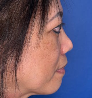 Rhinoplasty Before & After Gallery - Patient 796630 - Image 2