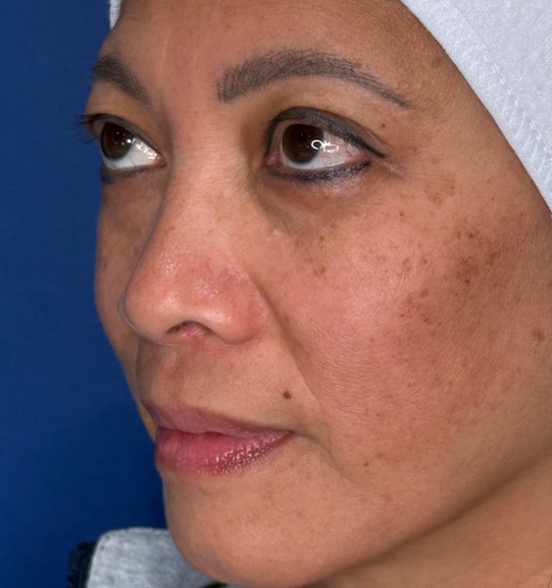 Rhinoplasty Before & After Gallery - Patient 796630 - Image 7