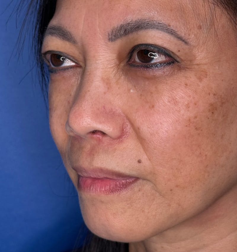 Rhinoplasty Before & After Gallery - Patient 796630 - Image 8