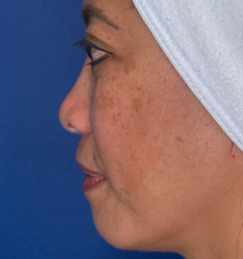 Rhinoplasty Before & After Gallery - Patient 796630 - Image 9