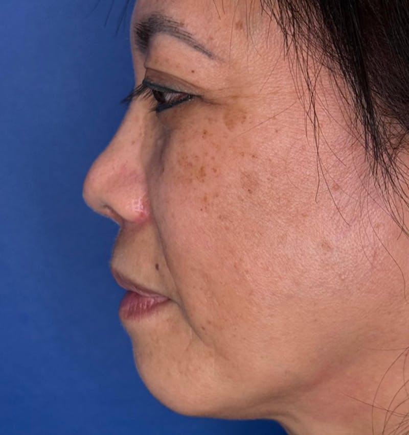 Rhinoplasty Before & After Gallery - Patient 796630 - Image 10