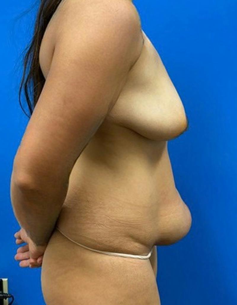 Mommy Makeover Before & After Gallery - Patient 183421 - Image 5