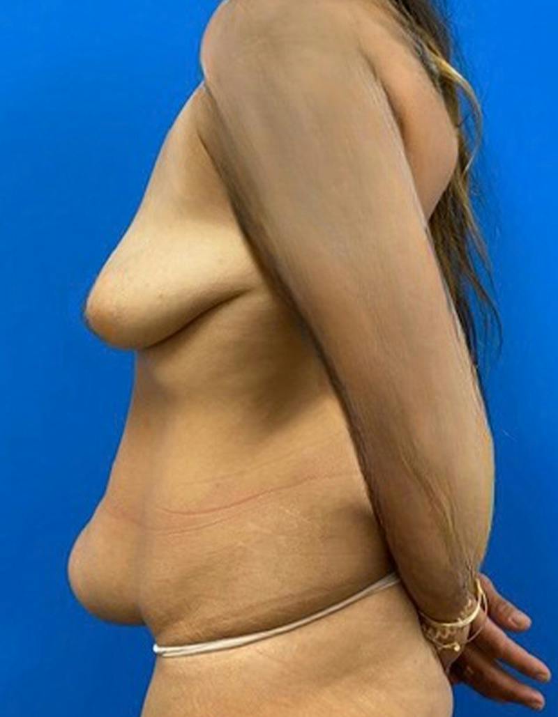 Mommy Makeover Before & After Gallery - Patient 183421 - Image 9