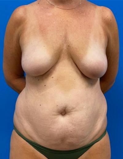 Mommy Makeover Before & After Gallery - Patient 163124 - Image 1