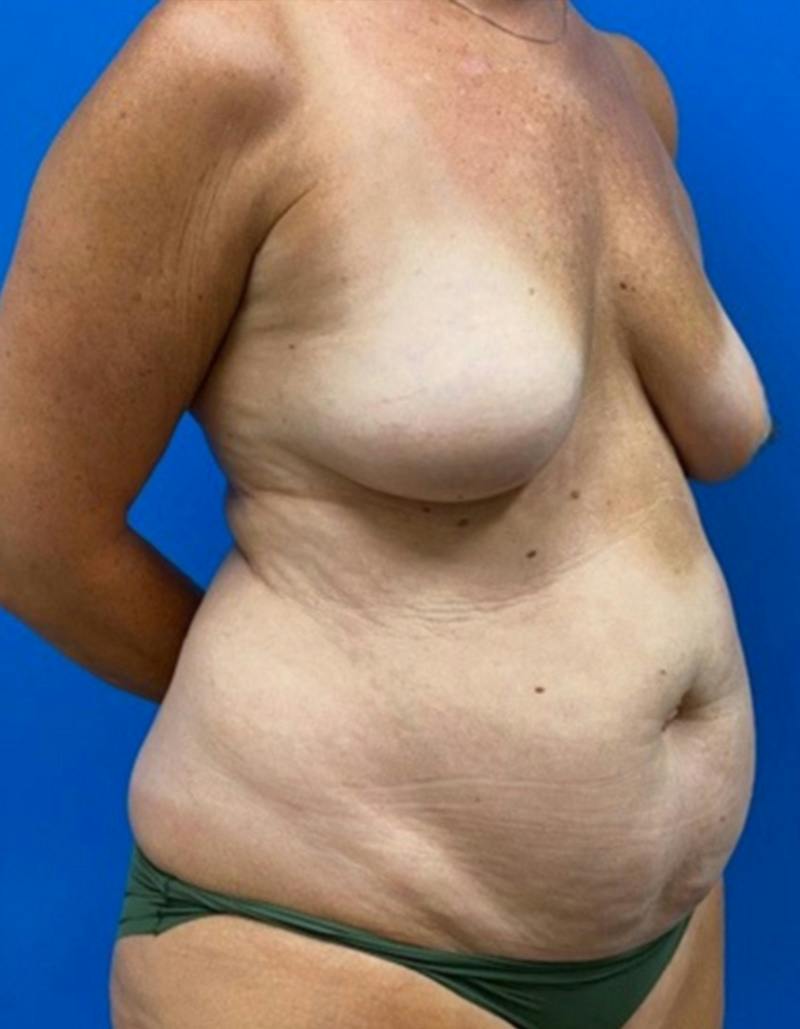 Mommy Makeover Before & After Gallery - Patient 163124 - Image 3