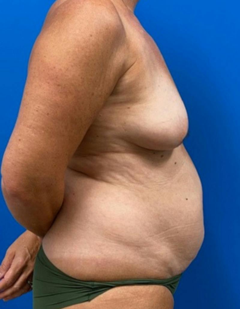 Mommy Makeover Before & After Gallery - Patient 163124 - Image 5