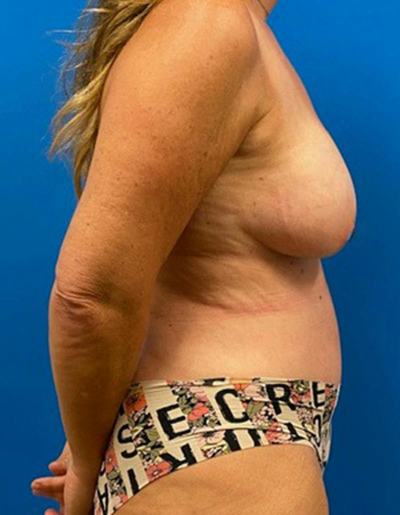 Mommy Makeover Before & After Gallery - Patient 163124 - Image 6