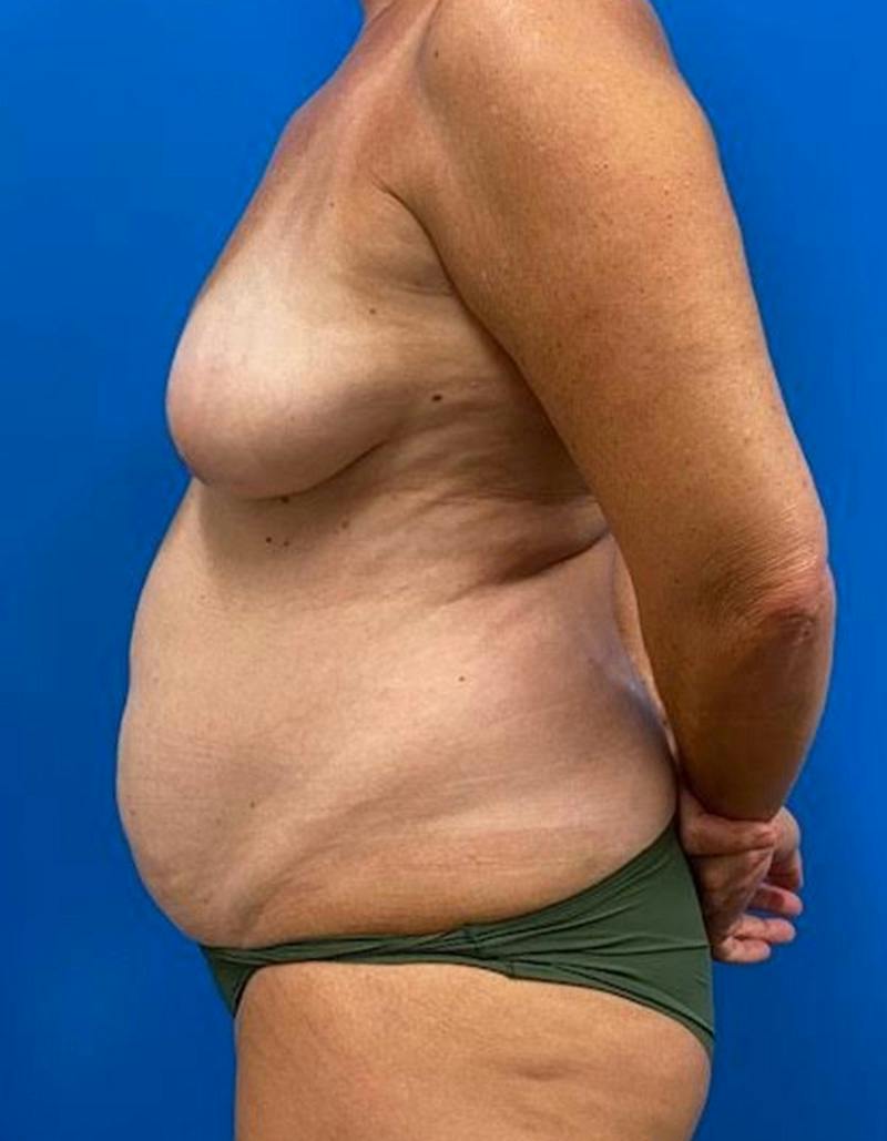 Mommy Makeover Before & After Gallery - Patient 163124 - Image 9