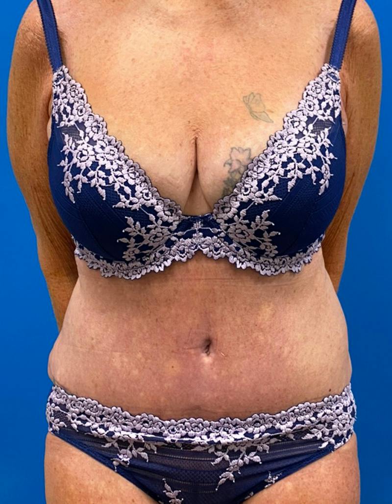Tummy Tuck Before & After Gallery - Patient 190515 - Image 2