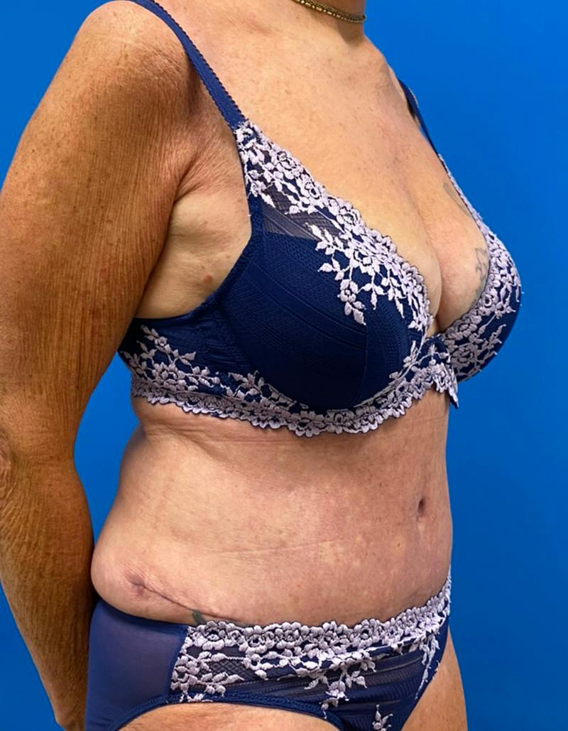 Tummy Tuck Before & After Gallery - Patient 190515 - Image 4