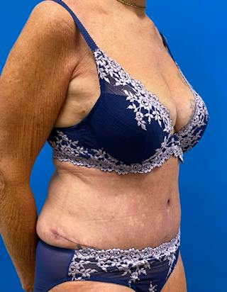 Tummy Tuck Before & After Gallery - Patient 190515 - Image 4
