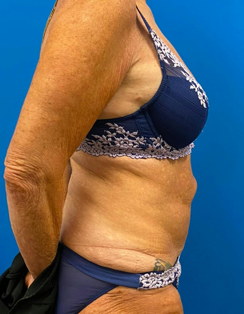 Tummy Tuck Before & After Gallery - Patient 190515 - Image 5
