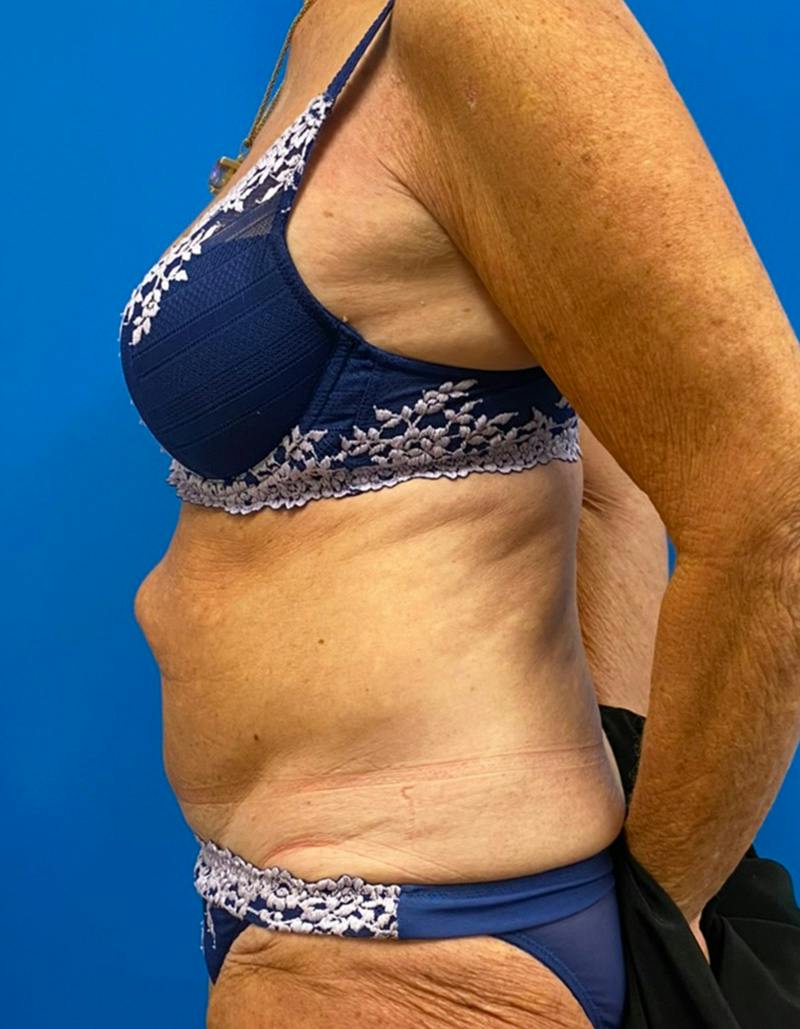 Tummy Tuck Before & After Gallery - Patient 190515 - Image 9