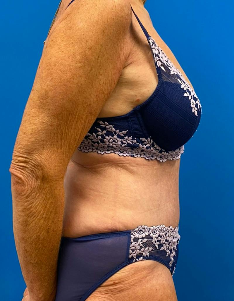 Tummy Tuck Before & After Gallery - Patient 190515 - Image 6