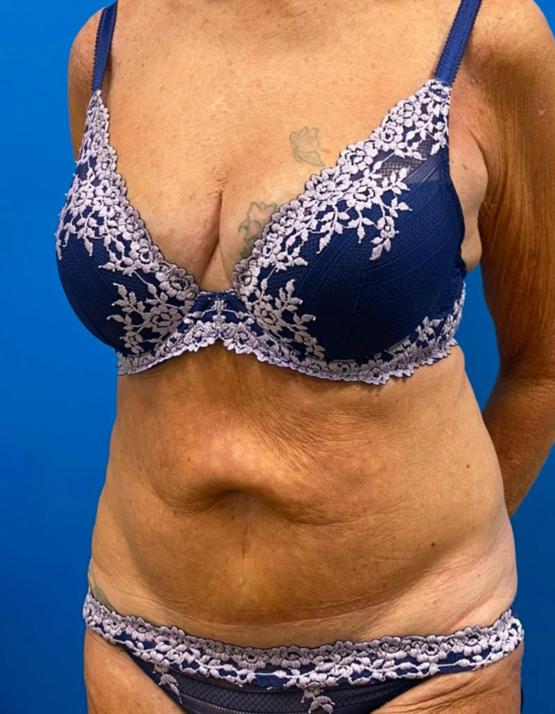 Tummy Tuck Before & After Gallery - Patient 190515 - Image 7