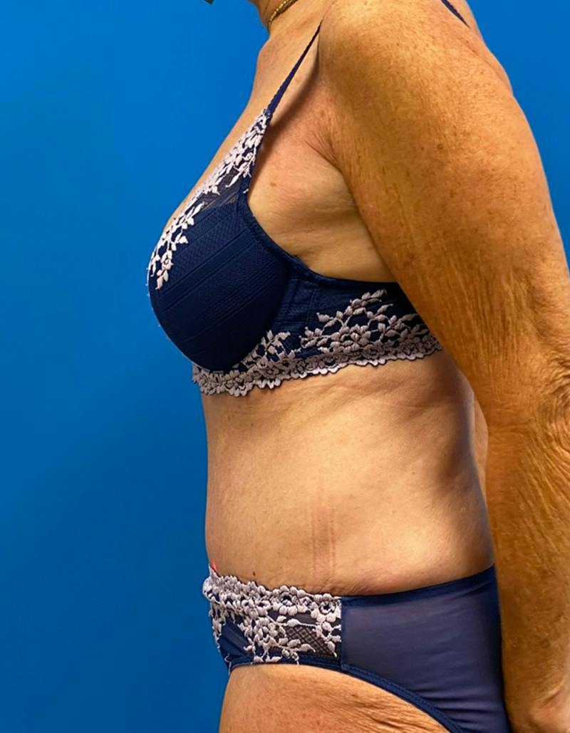 Tummy Tuck Before & After Gallery - Patient 190515 - Image 10