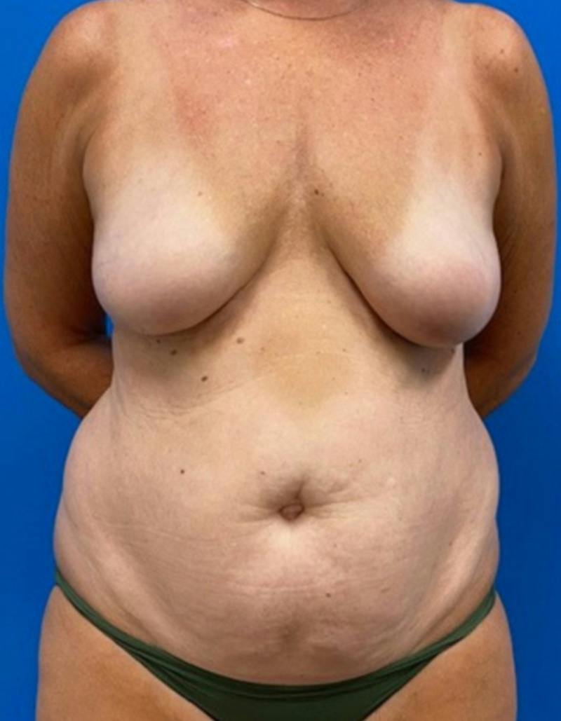 Tummy Tuck Before & After Gallery - Patient 282165 - Image 1