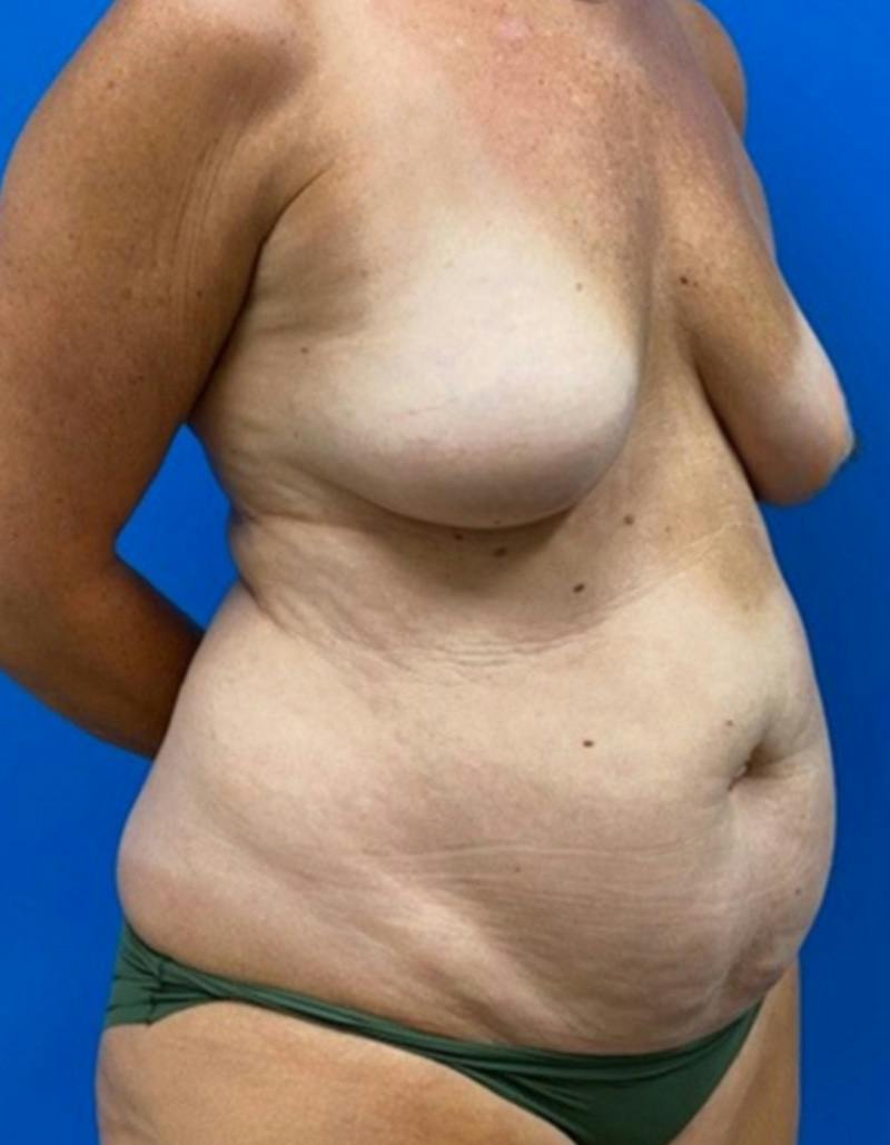 Tummy Tuck Before & After Gallery - Patient 282165 - Image 3