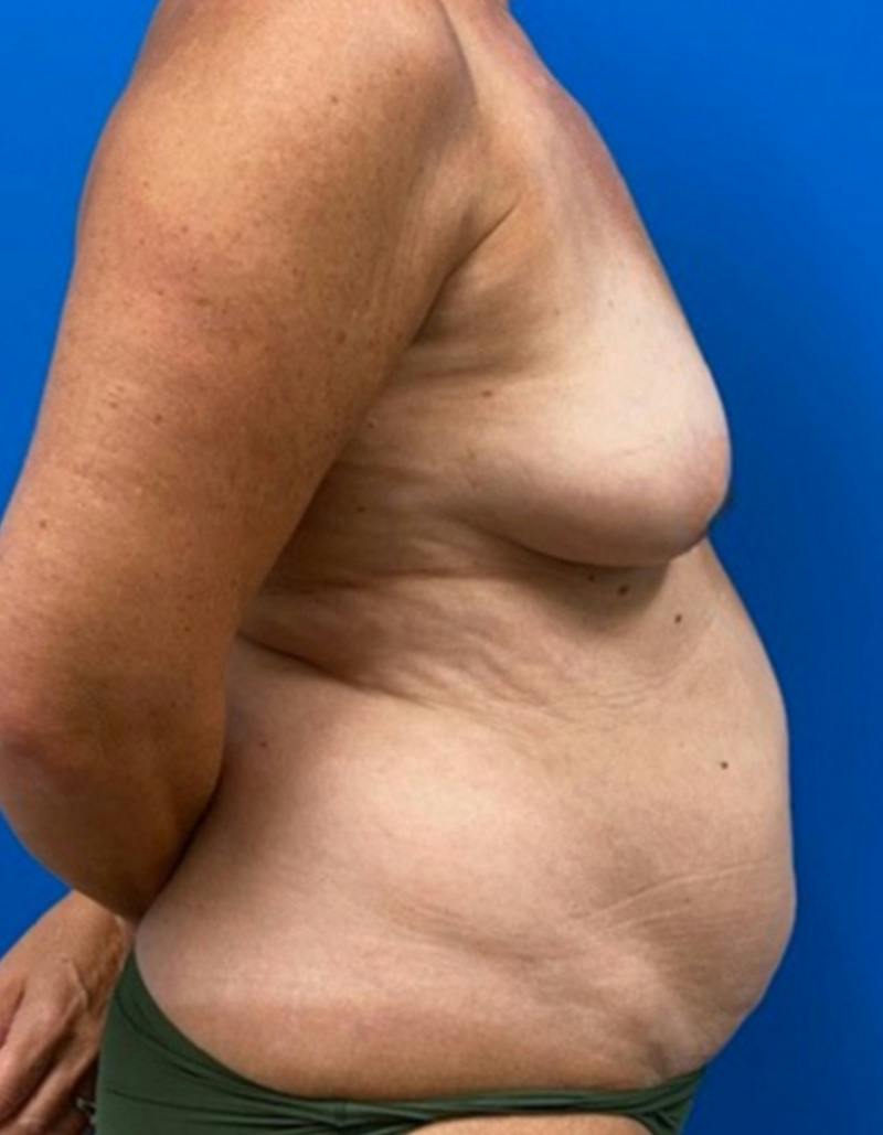 Tummy Tuck Before & After Gallery - Patient 282165 - Image 5