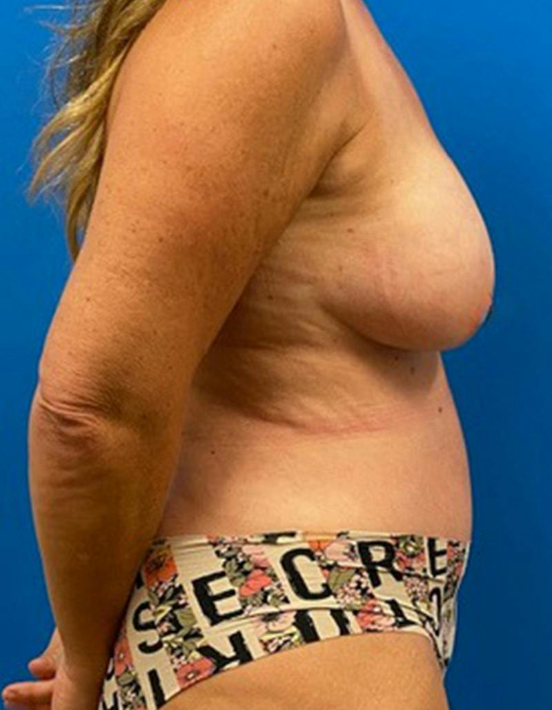 Tummy Tuck Before & After Gallery - Patient 282165 - Image 6