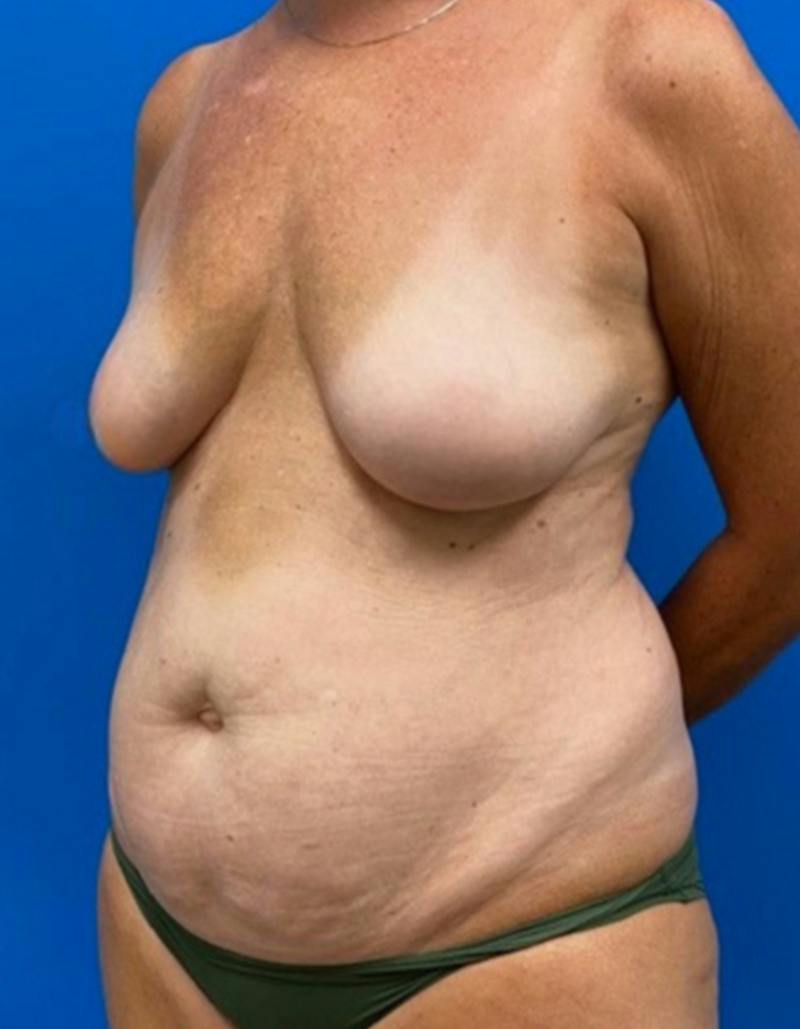 Tummy Tuck Before & After Gallery - Patient 282165 - Image 7
