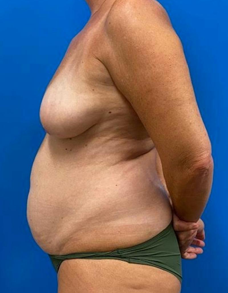 Tummy Tuck Before & After Gallery - Patient 282165 - Image 9