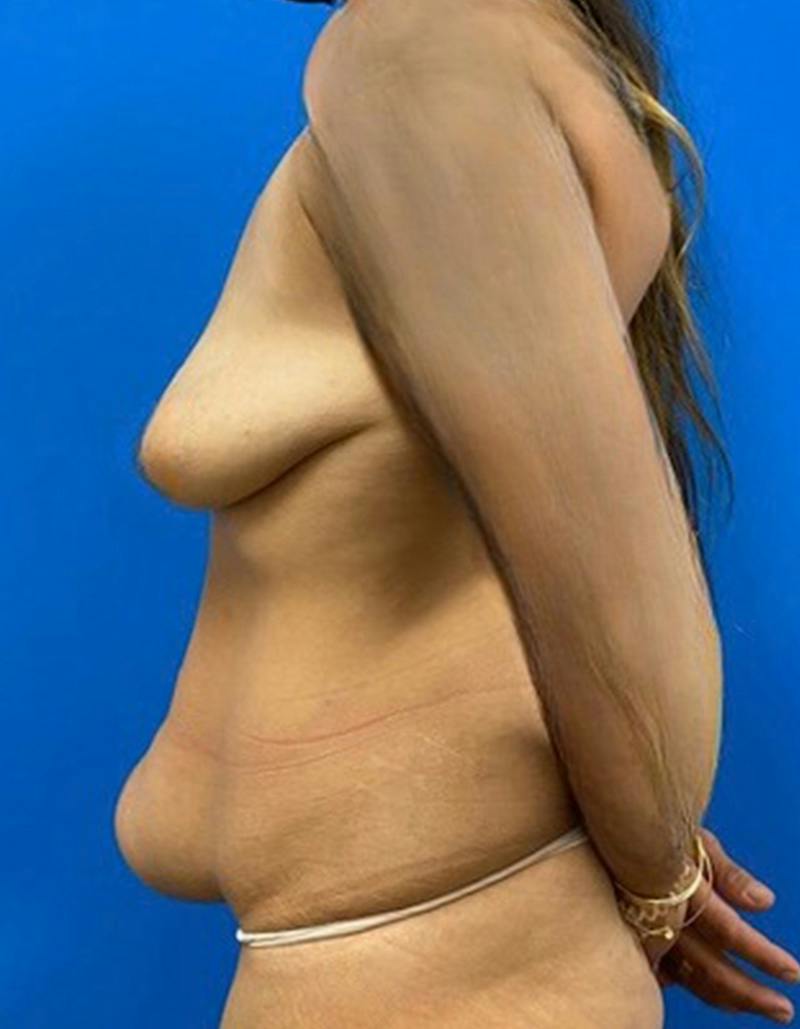 Tummy Tuck Before & After Gallery - Patient 154940 - Image 9