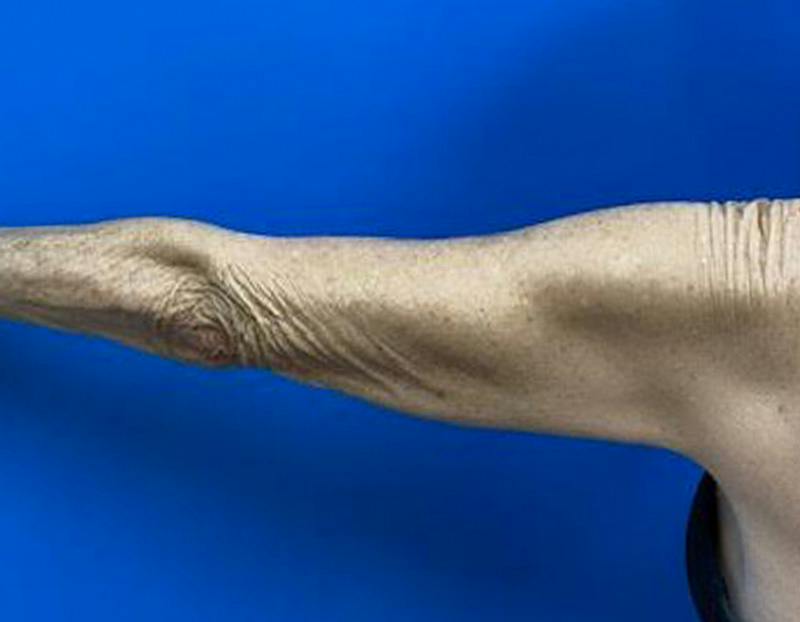 Arm Lift Before & After Gallery - Patient 249913 - Image 1
