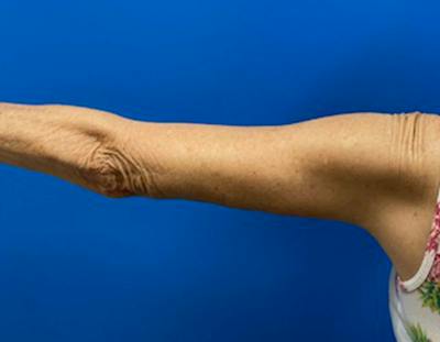 Arm Lift Before & After Gallery - Patient 249913 - Image 2