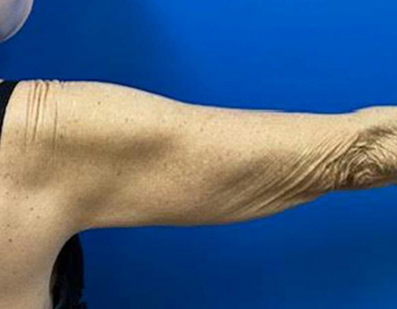 Arm Lift Before & After Gallery - Patient 249913 - Image 3