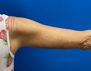Arm Lift Before & After Gallery - Patient 249913 - Image 4