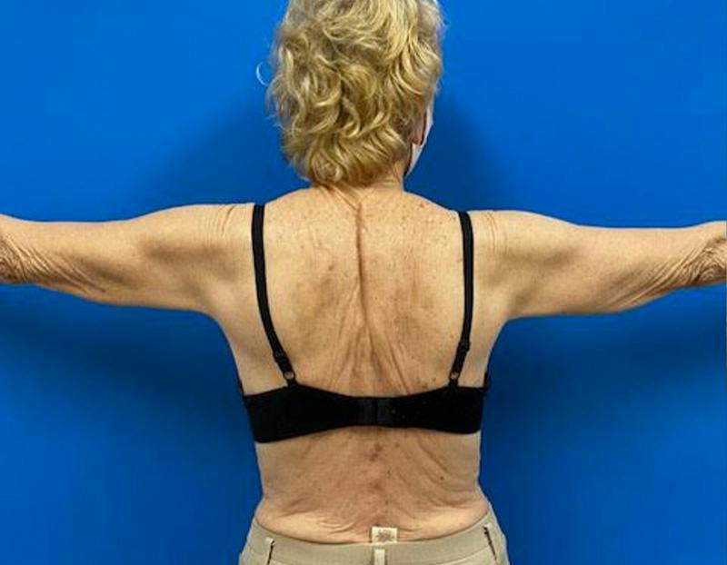 Arm Lift Before & After Gallery - Patient 249913 - Image 5