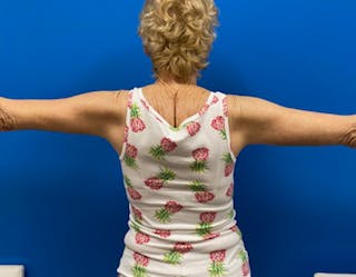 Arm Lift Before & After Gallery - Patient 249913 - Image 6