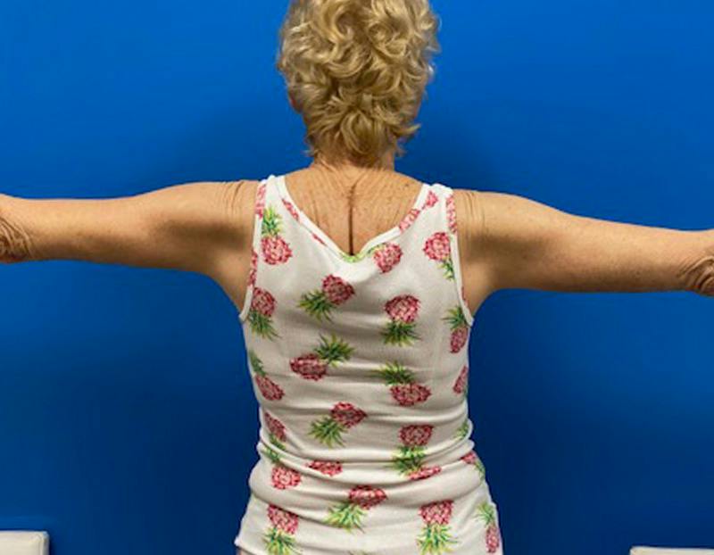 Arm Lift Before & After Gallery - Patient 249913 - Image 6