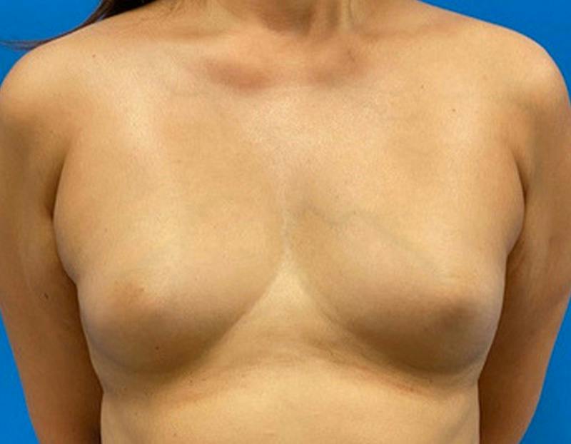 Breast Augmentation Before & After Gallery - Patient 360720 - Image 1